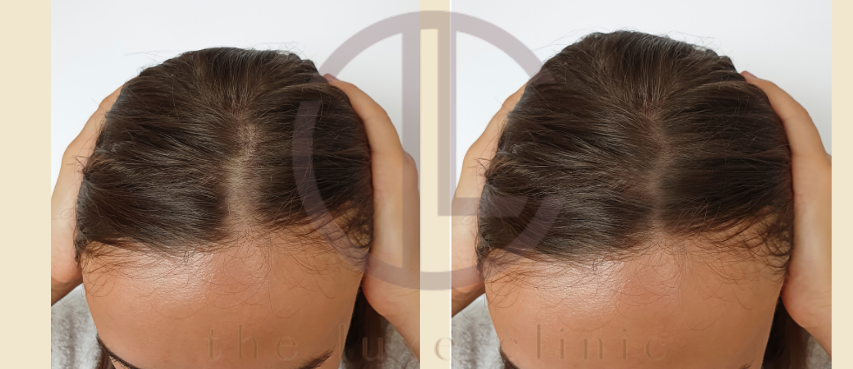 hair growth laser benefits side effects cost price malaysia