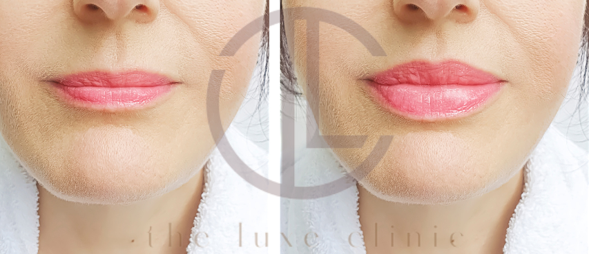 lip filler benefits side effects cost price malaysia