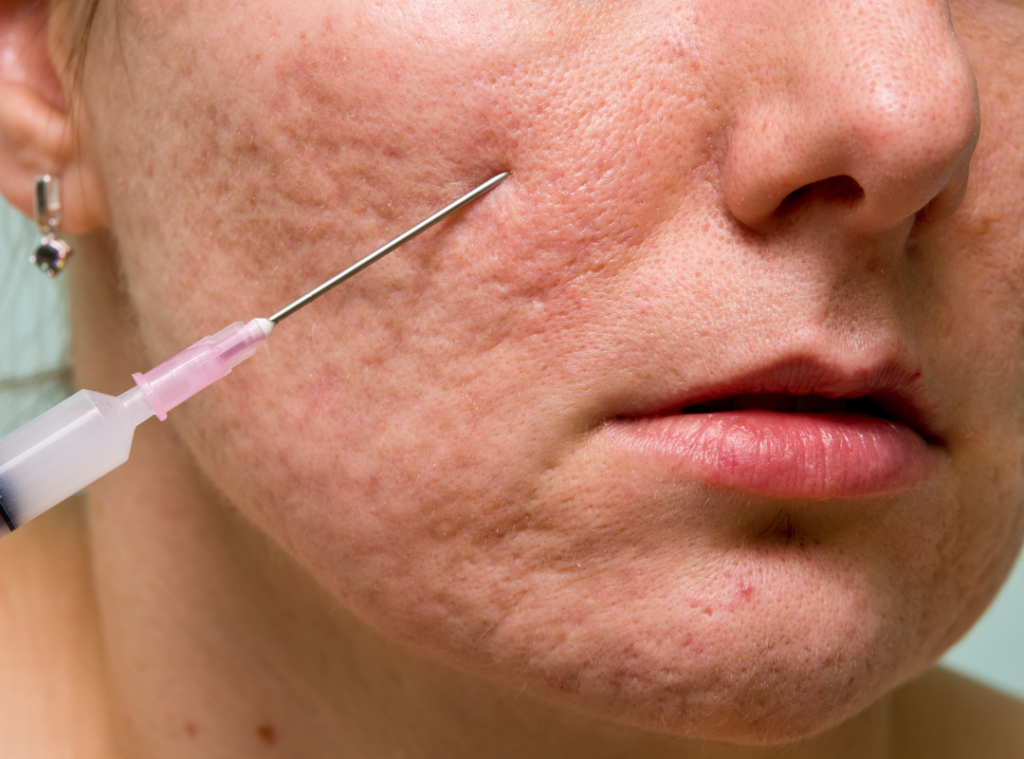 Subcision for deep acne scars