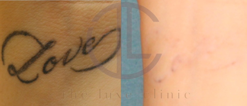 tattoo removal benefits side effects cost price malaysia