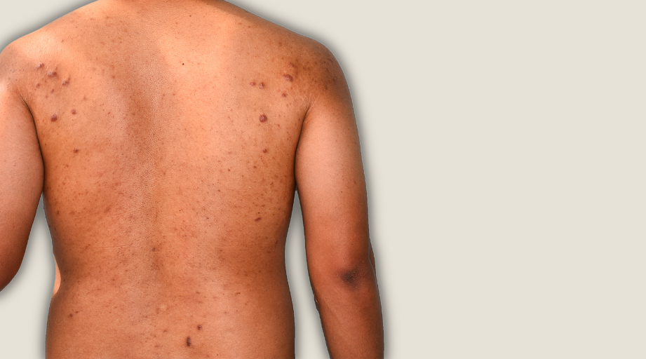 keloid injection treatment removal